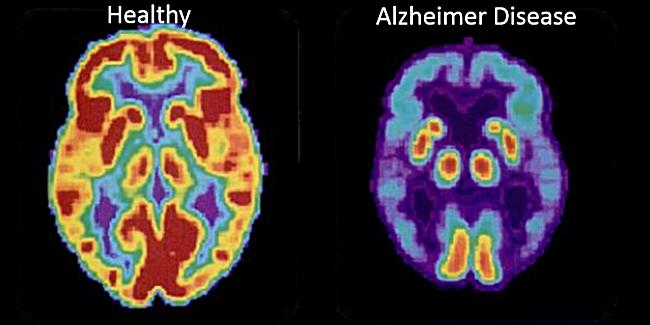 Alzheimer’s drug pipeline